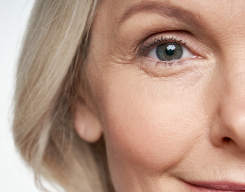 middle-age lady before a botox face treatment