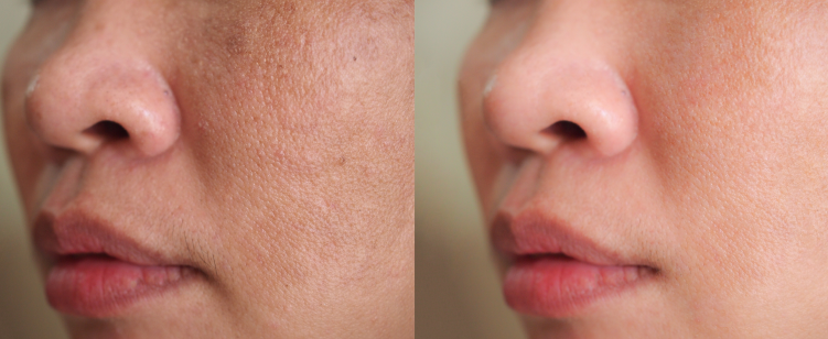 a before and after open pores treatment photo
